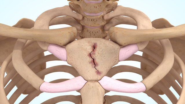 Manubrium bone fracture of 3d illustration