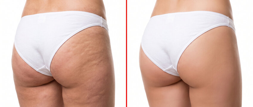  Before and after cellulite treatment comparison. Close-up of female buttocks and thighs in white underwear showing orange peel skin versus smooth firm skin. Beauty, healthcare and cosmetology concept