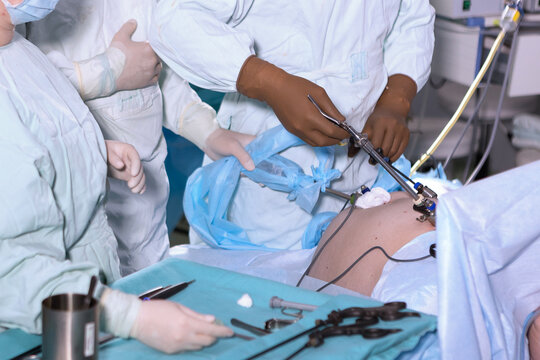 Surgical team performs laparoscopic surgery using endoscopic instruments in sterile operating room