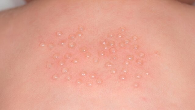 Clinical macro photo of pediatric miliaria crystallina dew drop vesicles on infant back
