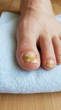 Infected toe condition: nail fungus, diseased plate, yellow discoloration, mycosis pathogen, human foot, medical issue, unhealthy keratin, skin damage, treatment need, dry towel.
