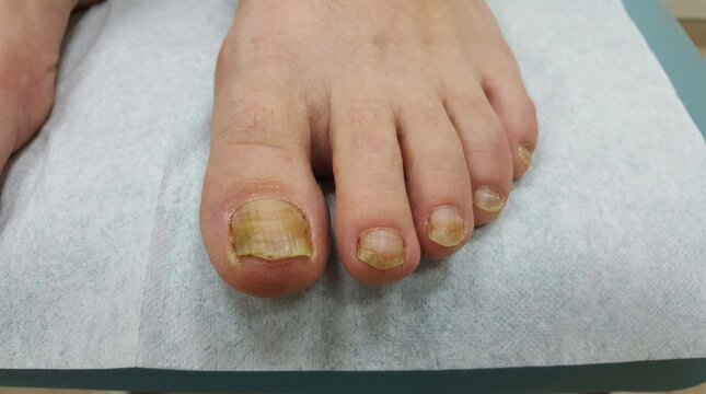 Keratin decay display: nail fungus, yellow toe, unhealthy plate, dermatophyte infection, medical condition, diseased foot, cuticle irritation, abnormal growth, clinic treatment.