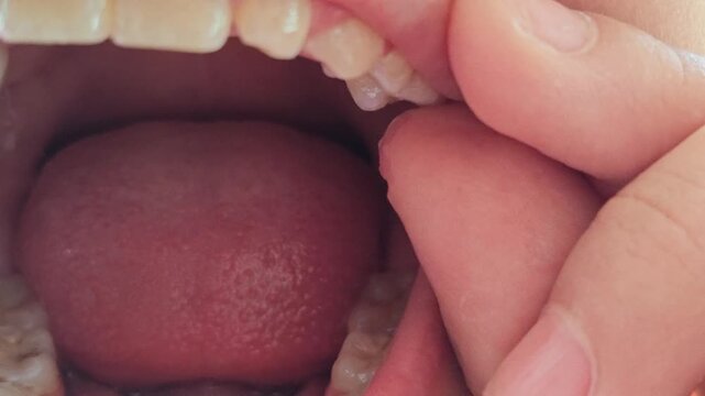 Close Up of Child Wiggling Loose Molar Tooth with Fingers