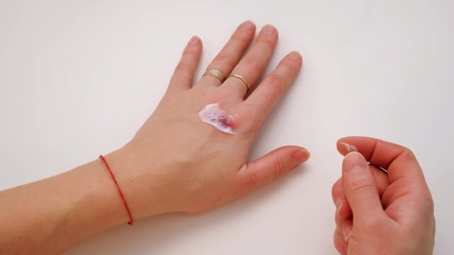 Burn on a woman hand. Selective focus.
