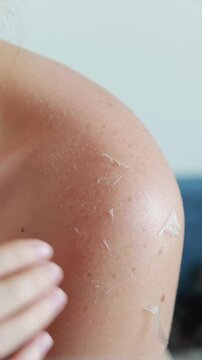 Close-up of a woman touching her sunburned shoulder with peeling skin after a beach vacation. Cellular Damage. Melanoma Awareness. insolation prevention