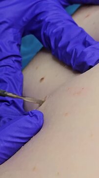 Doctor removing small papillomas with electrocoagulator during dermatology procedure in clinic