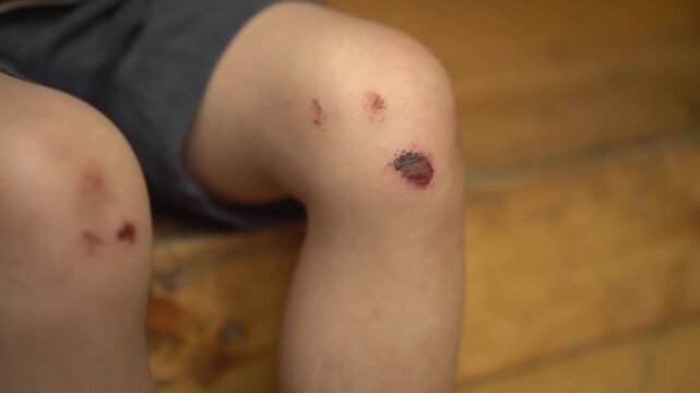Little Child Sitting on Stairs Touching Scraped Knees with Hands, Close Up