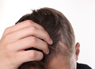 Fototapeta premium Dandruff problem. Man examining his head on white background, closeup
