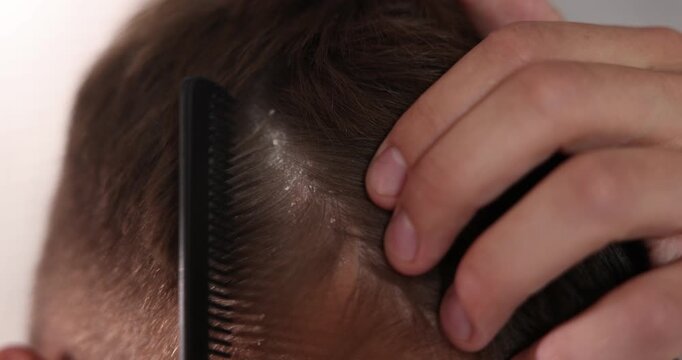 Dandruff problem. Man combing his hair at home, closeup. Camera moving forward