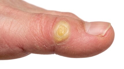 Fototapeta premium Hyperkeratotic Plantar Corn Heloma Durum Callus Spot on Human Toe Macro