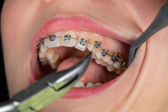 Dental braces examination, ororthodontic consultation
