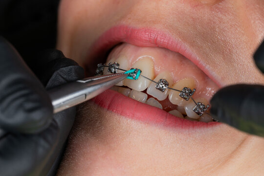 Dental braces examination, ororthodontic consultation