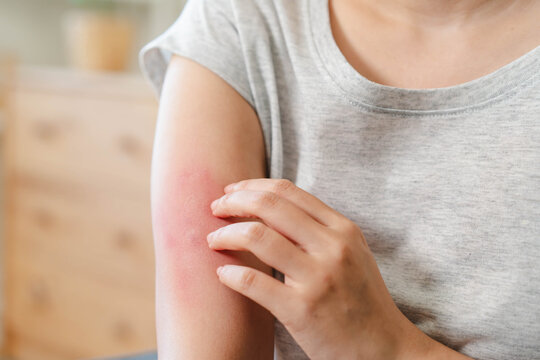 Sensitive skin allergic concept, Woman itching on her arm have a red rash from allergy symptom and from scratching