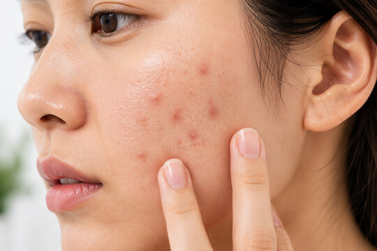 Close-up of acne and blemishes on young Asian woman's cheek