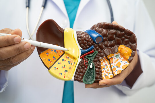 Cirrhosis, Liver cancer, fatty liver, Asian doctor with liver human model.