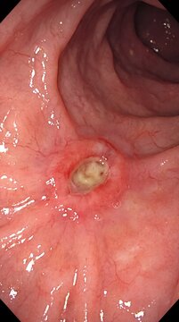 An endoscopic view shows a gastric ulcer on the stomach lining, highlighting mucosal inflammation and gastrointestinal diagnosis.