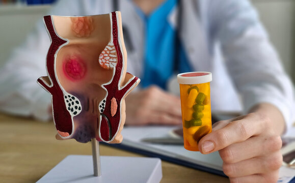 Doctor proctologist holding with pills and anatomical model of rectum