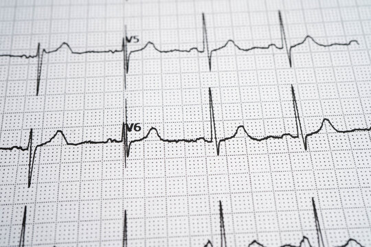 Electrocardiogram ECG, heart wave, heart attack, cardiogram report.