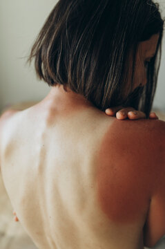 Rear view of severe sunburn on back and shoulder after sunbathing
