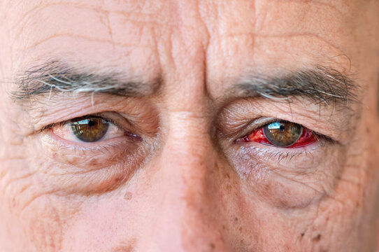 Comparison of healthy and subconjunctival hemorrhage eye in adult man, hyposphagma, red eye, ocular health, ophthalmology, medical diagnosis, intraocular pressure