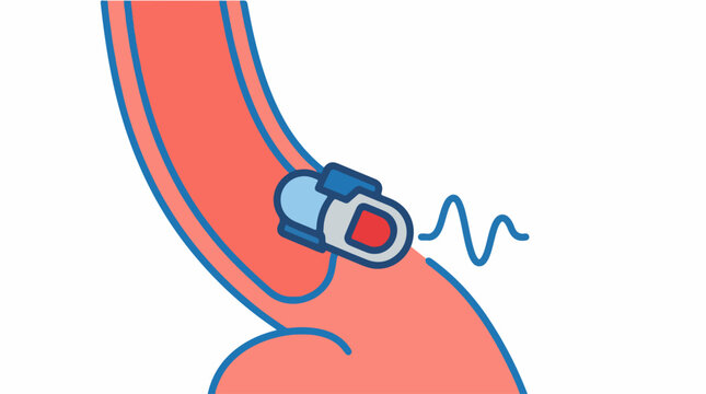 Esophageal manometry medical vector illustration, esophagus pressure test diagram, clinical diagnostic procedure icon