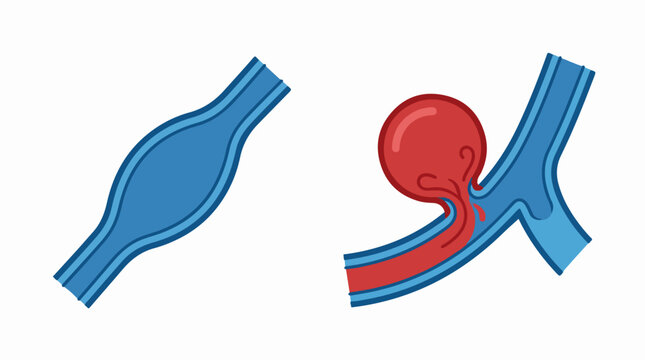 Aneurysm and normal blood vessel vector illustration