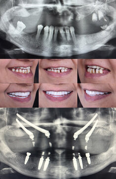 Fixed full arch implant supported dental prosthesis applied to edentulous individuals in dentistry. Full arch dental prosthesis fixed on only four implants. This implant surgery