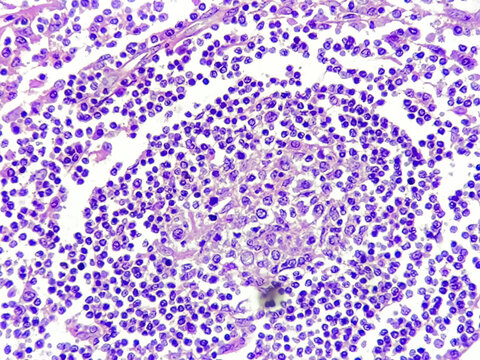 Rosai-Dorfman disease (RDD) also known as sinus histiocytosis is a rare, noncancerous disorder involving the overgrowth and accumulation of white blood cells called histiocytes.