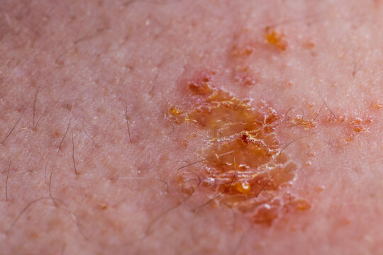 Poison Oak Rash On Human Skin