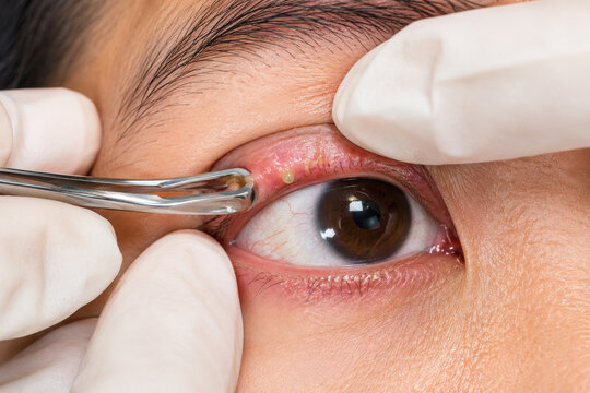 Doctor performs meibomian gland expression during eye treatment