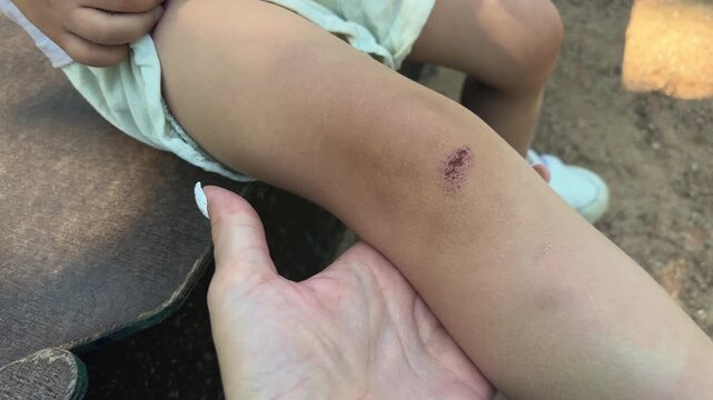Close view of a child's scraped knee with a minor abrasion outdoors, childhood injury, first aid, active play, skin care.