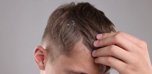 Fototapeta premium Dandruff problem. Man examining his head on grey background, closeup
