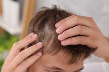 Fototapeta premium Dandruff problem. Young man examining his head at home, closeup