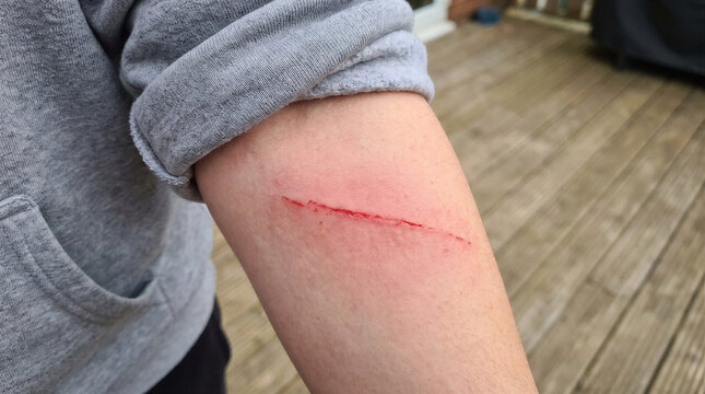 Fresh red scratch injury on a child's arm skin