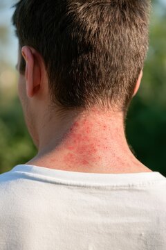 Male individual with visible skin irritation on the back of the neck, short hair, wearing a white shirt, outdoors with blurred greenery in the background