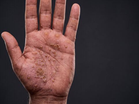 Palmoplantar Pustular Psoriasis with Sterile Yellow Pustules on Adult Palm, Chronic Inflammatory Skin Disease Macro Medical Photograph