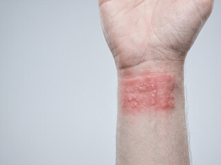 Fototapeta premium Allergic Contact Dermatitis Sharp Bordered Red Rash on Adult Wrist from Metal Sensitivity, Dermatology Patch Test Reference Photograph