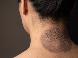 Fototapeta premium Lichen Simplex Chronicus Thickened Leathery Skin from Chronic Scratching on Adult Nape, Neurodermatitis Dermatology Close Up Image