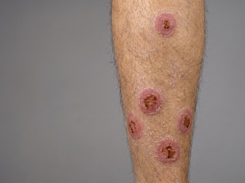 Nummular Discoid Eczema Coin Shaped Crusted Lesions on Adult Lower Leg, Chronic Dermatitis Medical Stock Reference Photograph