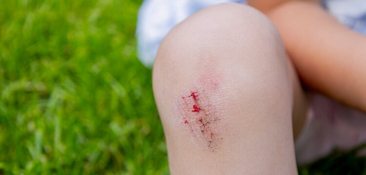 Close up of child scraped knee wound with dirt on green grass background.