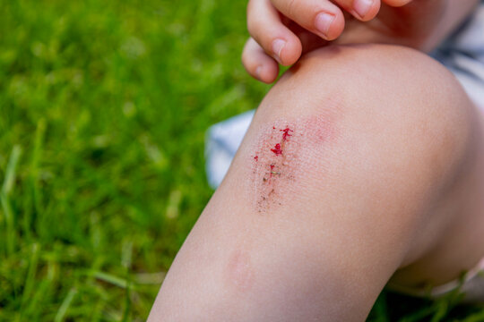 Close up of child scraped knee wound with dirt on green grass background.