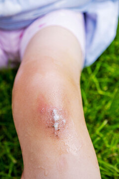 Disinfecting child scraped knee wound with foaming peroxide outdoors