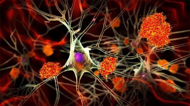 Neurons in Alzheimer&rsquo;s disease, 3D animation showing cortical nerve cells with beta-amyloid plaques and intracellular tau tangles affecting synaptic connections.