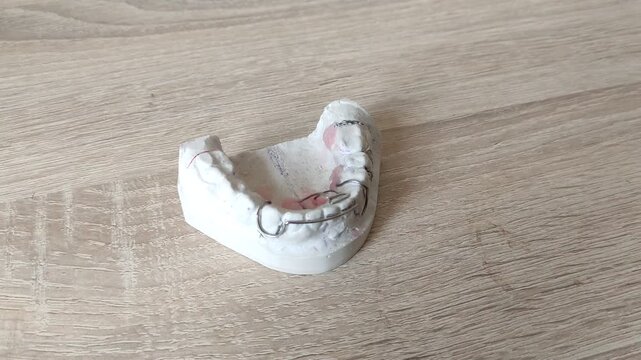 White plaster dental cast with metal wire retainer and clasps on a wooden table