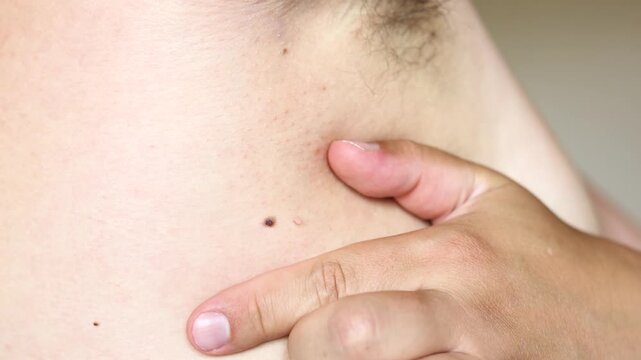 Slow motion closeup of male fingers touching skin tags in armpit. Visual concept for cancer awareness insulin resistance sugar intake sugary drinks and unhealthy diet.