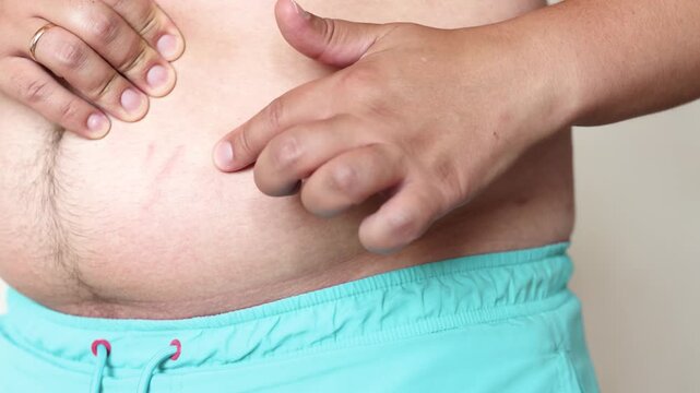 Slow motion closeup shows young man touching red stretch marks on abdomen. Visual concept for weight gain poor nutrition sugar intake and sugary drinks.