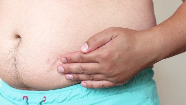 Slow motion closeup shows young man touching red stretch marks on abdomen. Visual concept for weight gain poor nutrition sugar intake and sugary drinks.
