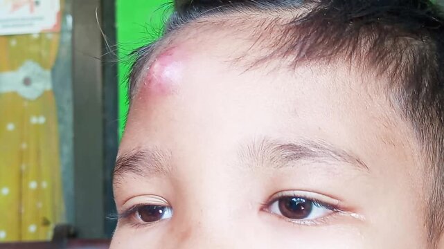 A bump on the forehead with a white center is a skin abscess caused by a boil or cystic acne. Avoid popping it yourself, as this can lead to infection; instead, consult a medical professional.