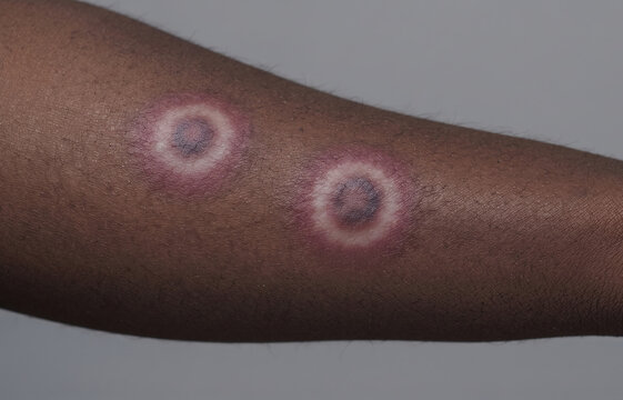 Erythema multiforme target lesions on dark skin arm