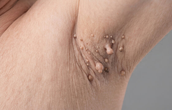Multiple Axillary Skin Tags Acrochordons Under Armpit
